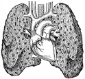 anatomy, diseased lungs engraving